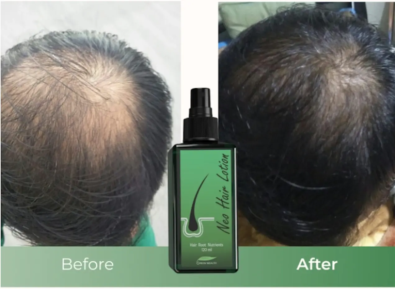 neo hair lotion result