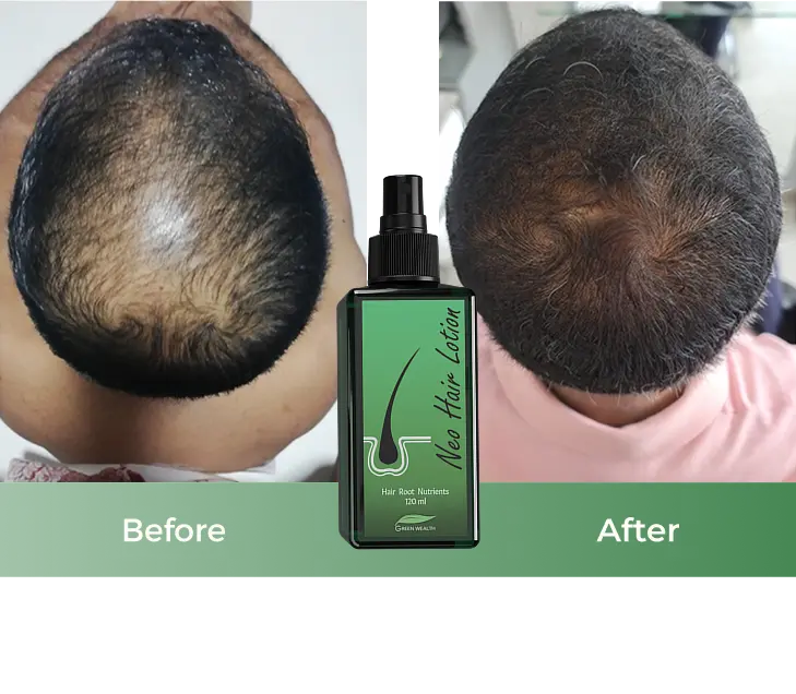 neo hair lotion result