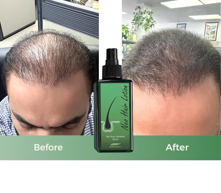 neo hair lotion result