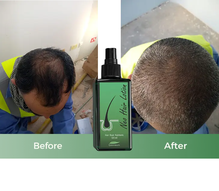 neo hair lotion result