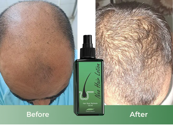 neo hair lotion result